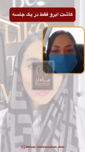 کاشت ابرو یک جلسه ای