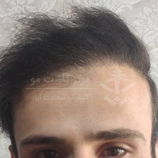 روش های جدید کاشت ابرو و مو