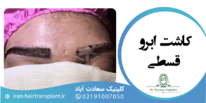 کاشت ابرو اقساطی