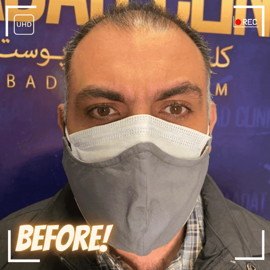 بهترین و جدیدترین روش کاشت مو چیست