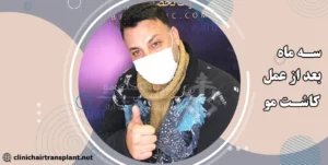 کاشت مو بعد از سه ماه به چه صورت خواهد بود؟