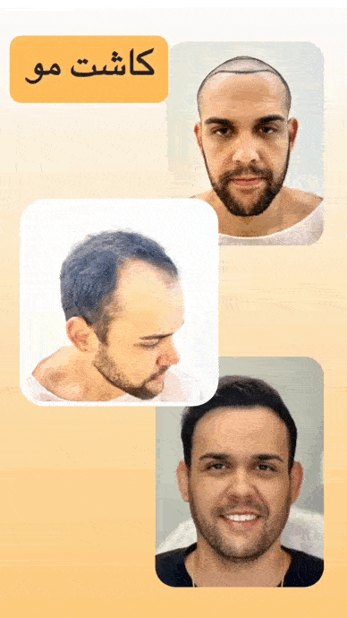 کاشت مو قبل و بعد