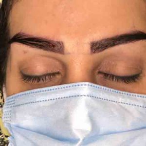 کاشت ابرو حرفه ای با خواب طبیعی
