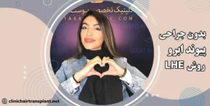 پیوند ابرو با روش ال اچ ای