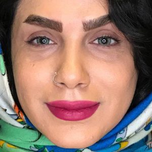 کاشت ابرو بدون نیاز به جراحی با روش LHE