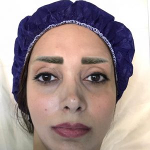 کاشت طبیعی ابرو بدون جراحی