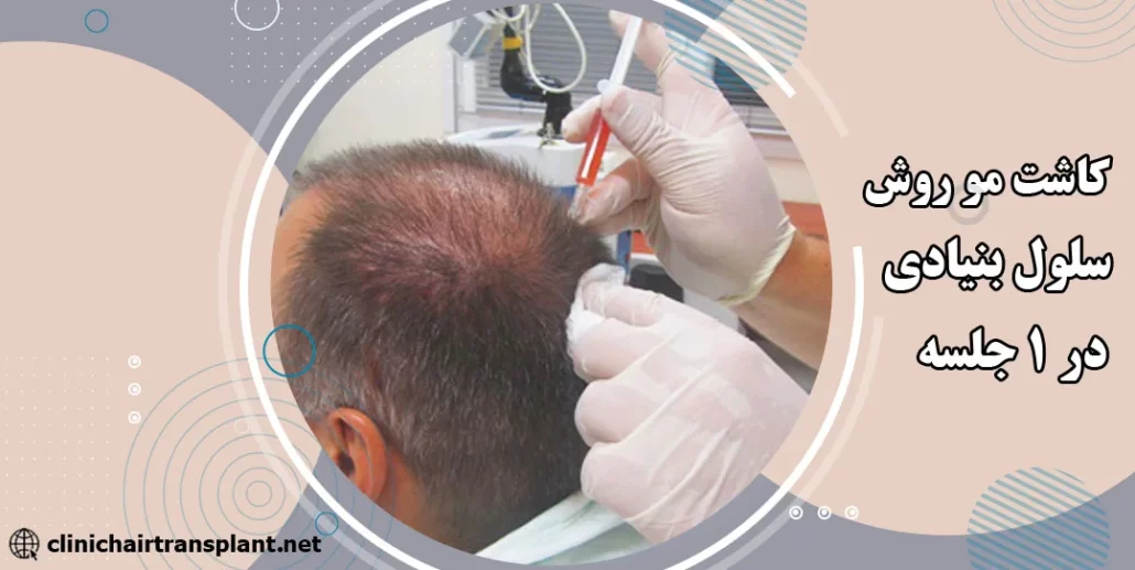 کاشت مو به روش سلول های بنیادی