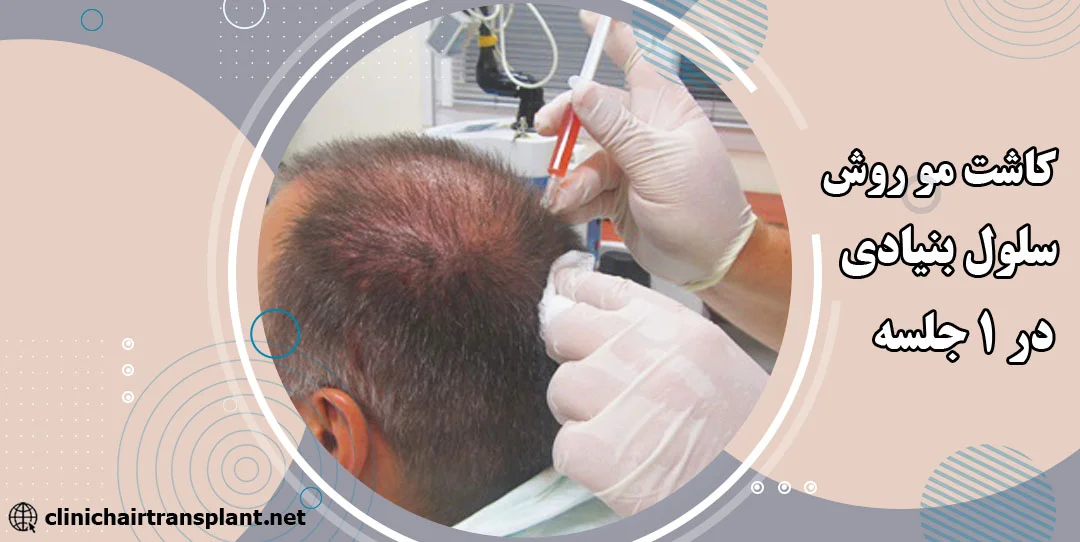 کاشت مو روش سلول‌های بنیادی