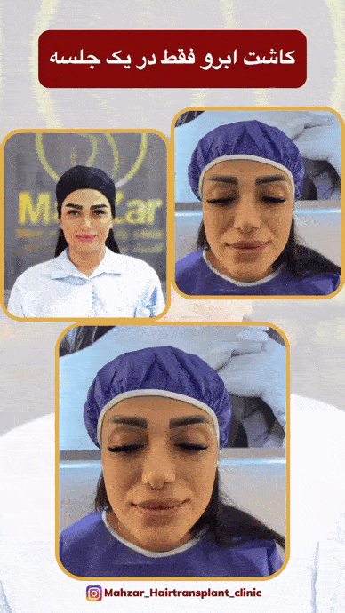 کاشت ابرو در کلینیک ماه زر-همه چیز درباره کاشت ابرو LHE