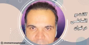 کاشت مو اقساطی