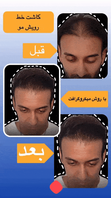 کاشت موی سر قبل و بعد