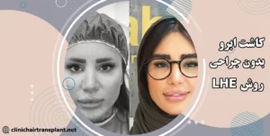 کاشت ابرو ال اچ ای روش بدون جراحی