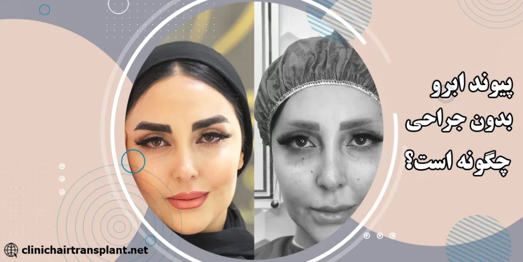 پیوند ابرو بدون جراحی
