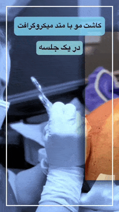 کاشت مو در مرکز ماه زر-کاشت مو بدون بانک مو