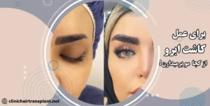 برای کاشت ابرو از کجا مو برمیدارن؟