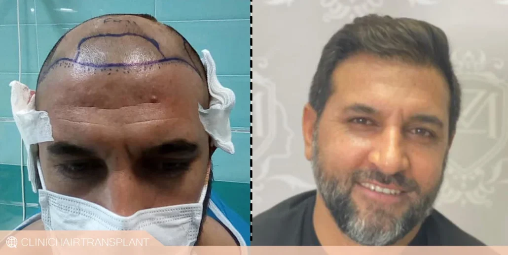 مراحل کاشت مو به روش تکثیر