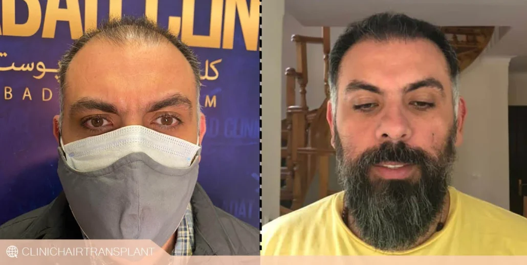 مقایسه کاشت موهای کم پشت در زنان و مردان