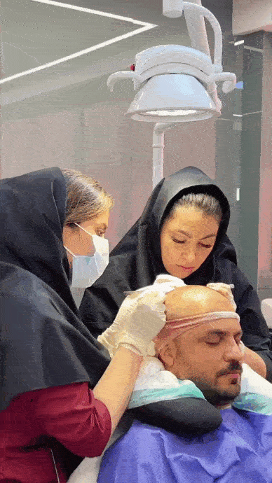 کاشت مو برای موهای کم پشت