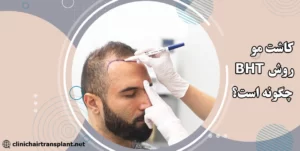 کاشت مو به روش BHT چگونه است؟