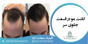 کاشت مو برای موهای کم پشت