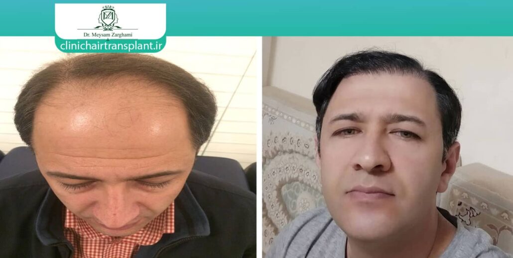 گرافت مو چیست؟