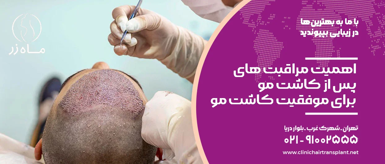 اهمیت مراقبت های پس از کاشت مو برای موفقیت کاشت مو