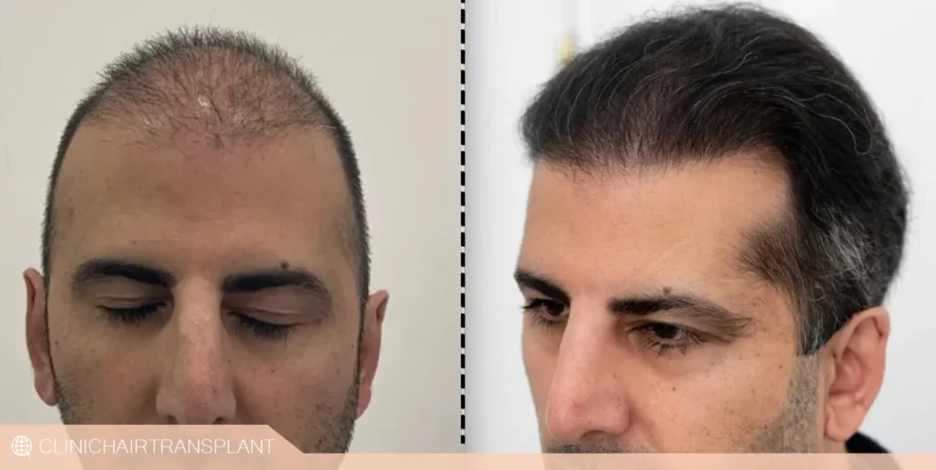 موفقیت کاشت مو