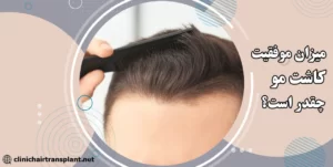 میزان موفقیت در کاشت مو چقدر است؟