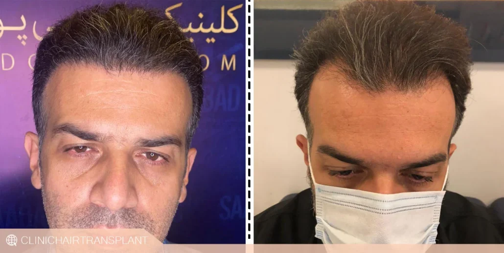 کاشتن مو در شقیقه