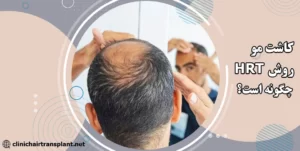 کاشت مو به روش hrt