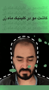 کاشت مو کلینیک ماه زر