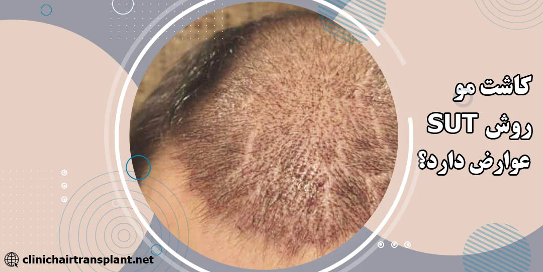 عوارض کاشت مو sut چیست؟