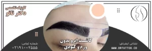 کاشت ابرو بدون ورم