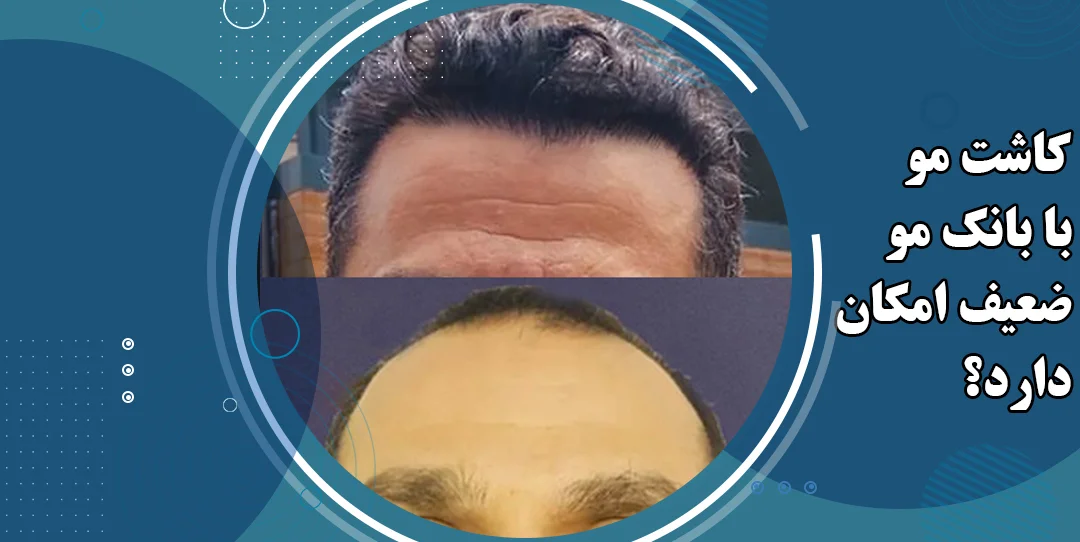 کاشت مو با بانک مو ضعیف امکان دارد؟