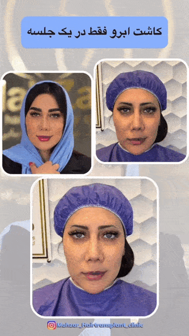 قبل و بعد کاشت ابرو