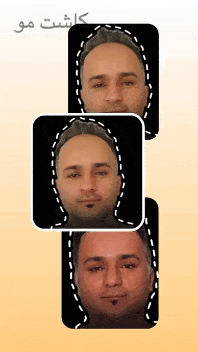 کاشت مو با تراکم بالا