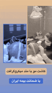 کاشت مو تضمینی