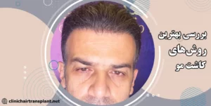 روش کاشت موی سر