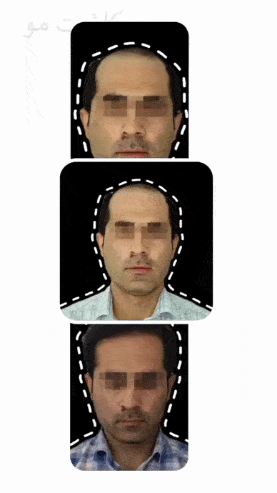 قبل و بعد کاشت مو