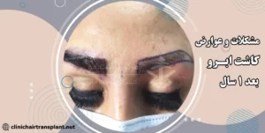 مشکلات کاشت ابرو