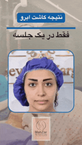 نتیجه کاشت ابرو