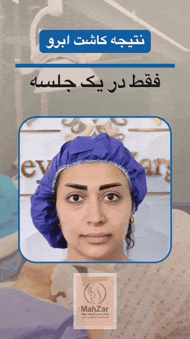 نتیجه کاشت ابرو