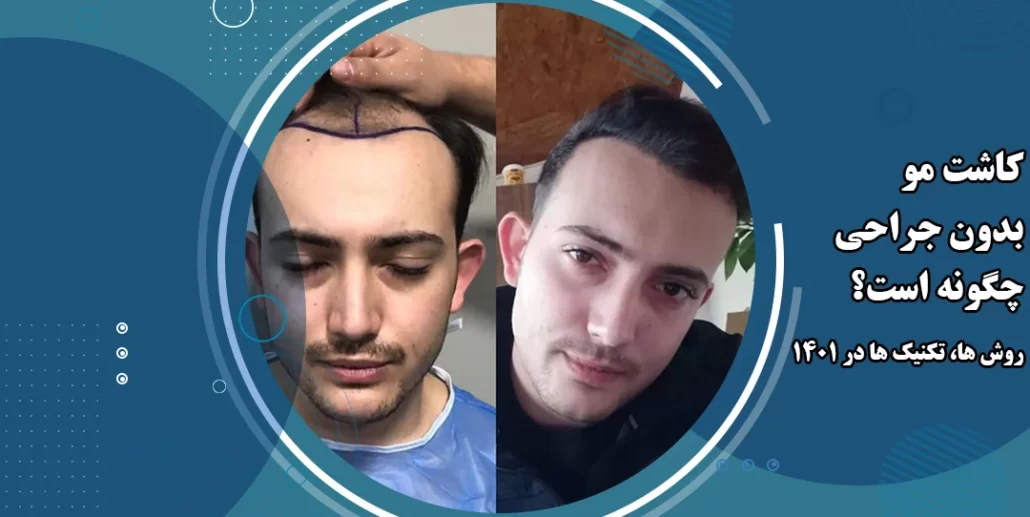 کاشت مو بدون جراحی چگونه است؟