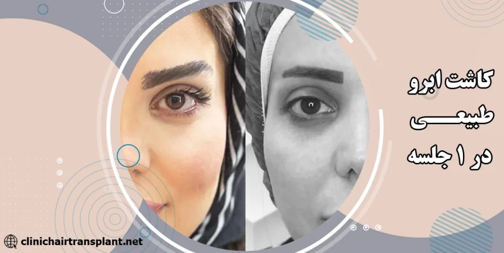 کاشت ابرو طبیعی در 1 جلسه