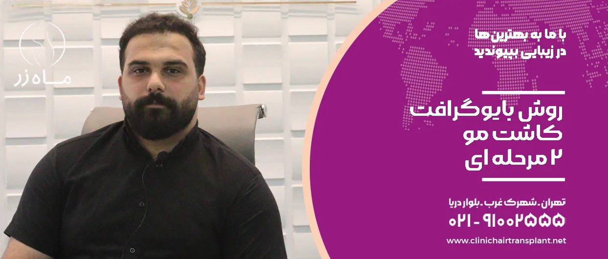 روش بایوگرافت کاشت مو 2 مرحله ای