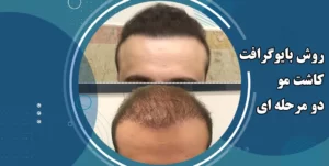 روش بایوگرافت کاشت مو 2 مرحله ای
