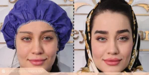 هزینه کاشت ابرو چقدر است؟