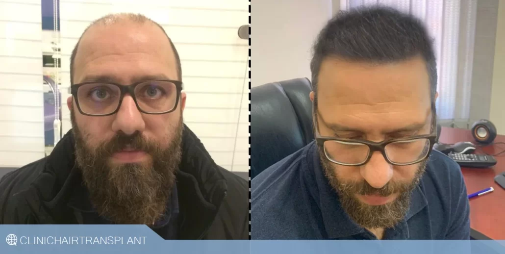 زمان نتیجه کاشت مو rht