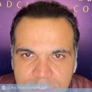 قیمت کاشت مو rht
