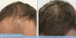 مقایسه قبل و بعد کاشت rht با fue